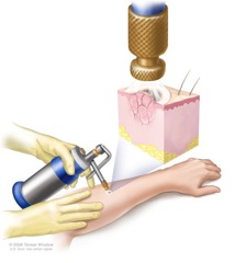 cryotherapy-liquid-nitrogen