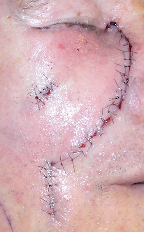 Sutures to face